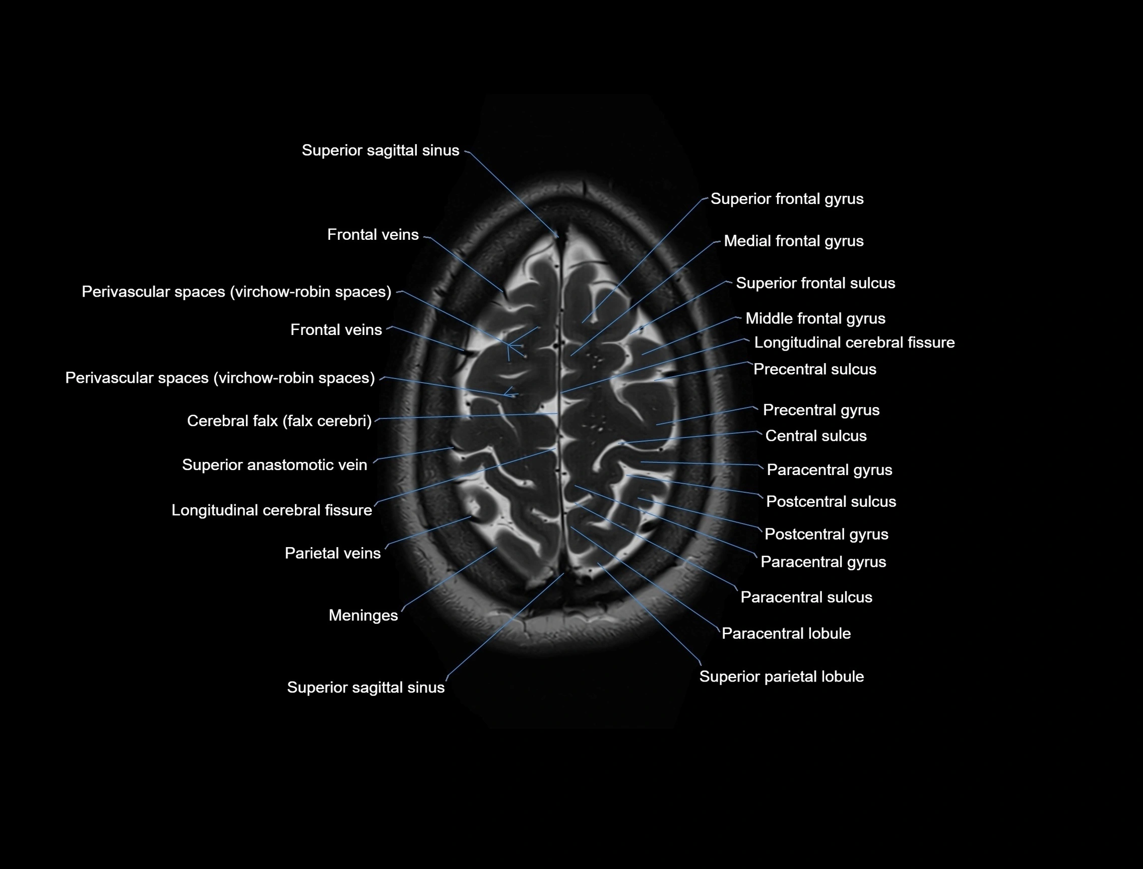 MRI Brain axial cross sectional radiology anatomy 3T image  -img-00001-00052.webp